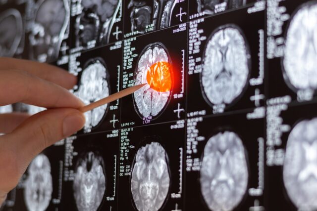 traumatic brain injury